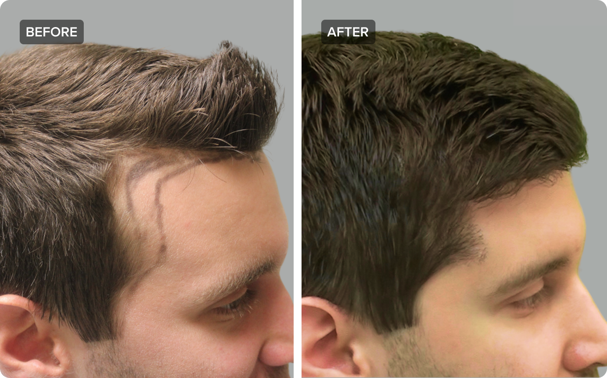 Hair Transplant in Islamabad