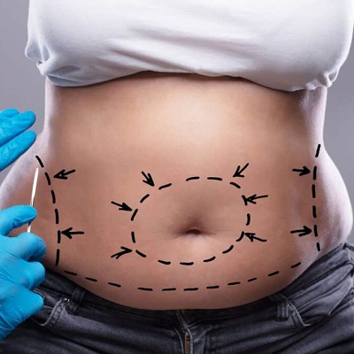 Your Guide to a Smoother, Tighter Abdomen: Exploring Tummy Tuck Benefits in Riyadh