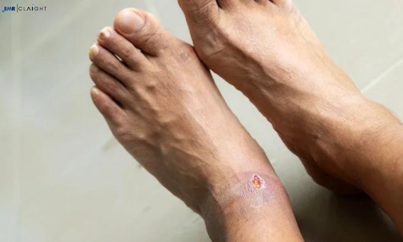 Global Diabetic foot ulcers (DFUs) are among the most common and severe complications associated with diabetes. They not only impose significant physical and emotional strain on patients but also place a heavy financial burden on healthcare systems worldwide. In 2023, the diabetic foot ulcers market was valued at USD 6.32 billion, largely driven by the rising incidence of diabetes in the seven major markets (7MM), which include the United States, France, Germany, Italy, Spain, the United Kingdom, and Japan. The market is projected to grow at a compound annual growth rate (CAGR) of 5.85% during the forecast period from 2024 to 2032, reaching USD 10.5 billion by 2032. This article explores the key factors driving the market growth, the latest trends, and the outlook for the coming years. Market Overview Diabetic foot ulcers are a type of chronic wound that occurs in approximately 15% of diabetic patients during their lifetime. These wounds, often located on the bottom of the foot, can become infected and lead to severe complications such as gangrene or amputation if left untreated. The rising global incidence of diabetes, combined with longer life expectancies and increased obesity rates, has contributed to a higher prevalence of diabetic foot ulcers, which in turn is driving the demand for advanced treatments and medical technologies. The 7 major markets (7MM) represent a significant portion of global diabetes patients, and the diabetic foot ulcers market in these regions has seen steady growth in recent years. In 2023, the market size was valued at USD 6.32 billion, and it is expected to grow to USD 6.7 billion by 2024. By 2032, market projections indicate a value of USD 10.5 billion, as the demand for effective treatments and therapies continues to rise. Get a Free Sample Report with Table of Contents: https://www.expertmarketresearch.com/reports/diabetic-foot-ulcers-market/requestsample Key Drivers of Market Growth Increasing Prevalence of Diabetes The primary driver of growth in the diabetic foot ulcers market is the rising prevalence of diabetes worldwide. According to the International Diabetes Federation (IDF), the global number of diabetes patients is expected to reach 783 million by 2045. With diabetes being the leading cause of foot ulcers, this growing patient population has resulted in increased demand for advanced diabetic foot ulcer treatments. Aging Population The aging global population is another critical factor contributing to the rise in diabetic foot ulcers. Older individuals are more likely to suffer from chronic health conditions, including diabetes. As life expectancies increase, the prevalence of diabetes and its complications, such as diabetic foot ulcers, will continue to rise, further boosting market demand. Rising Healthcare Expenditure Governments and healthcare organizations are increasingly prioritizing diabetes management and treatment, leading to higher healthcare expenditure on chronic wound care, including diabetic foot ulcers. This growing investment is expected to fuel market growth, particularly in developed countries with well-established healthcare systems. Advancements in Wound Care Technologies The development of advanced wound care products and technologies has revolutionized the treatment of diabetic foot ulcers. Innovations such as bioengineered skin substitutes, growth factors, and negative pressure wound therapy (NPWT) have improved healing outcomes and reduced the risk of infection. These advancements are gaining widespread adoption in both hospitals and outpatient settings, driving market expansion. Increasing Awareness and Early Diagnosis Public health campaigns and initiatives focused on diabetes management have led to increased awareness of diabetic foot ulcers and their complications. Early diagnosis and treatment are critical to preventing severe outcomes, such as infections or amputations, which has spurred demand for preventive and therapeutic solutions in the market. Market Segmentation The diabetic foot ulcers market can be segmented based on treatment type, end user, and region. 1. Treatment Type Wound Care Dressings: Traditional and advanced dressings such as hydrogels, alginates, and foam dressings are commonly used to manage diabetic foot ulcers. These products help to maintain a moist wound environment, which is essential for proper healing. Debridement: This involves the removal of dead tissue from the wound to promote healing. Debridement can be performed surgically, enzymatically, or through autolytic methods. Bioengineered Skin Substitutes: These products mimic natural skin and are used to cover wounds and promote tissue regeneration. They are particularly effective in treating chronic wounds such as diabetic foot ulcers. Growth Factors: Topical growth factors are used to stimulate the body's natural healing processes and improve wound healing. Negative Pressure Wound Therapy (NPWT): This advanced therapy involves applying controlled negative pressure to the wound to promote faster healing and reduce the risk of infection. 2. End User Hospitals: Hospitals are the primary treatment centers for patients with severe diabetic foot ulcers, especially those requiring surgical interventions or advanced therapies. Outpatient Settings: Many diabetic foot ulcers can be managed in outpatient clinics, where patients receive regular wound care and monitoring. Home Care: With the rise of telemedicine and home healthcare services, more patients are receiving treatment for diabetic foot ulcers in the comfort of their homes. 3. Regional Analysis The diabetic foot ulcers market is dominated by the 7 major markets (7MM), which include the United States, France, Germany, Italy, Spain, the United Kingdom, and Japan. These regions have well-developed healthcare systems and a high prevalence of diabetes, making them key players in the global market. United States: The U.S. holds the largest market share due to the high prevalence of diabetes and advanced healthcare infrastructure. Rising healthcare expenditure and government initiatives to improve diabetes management are expected to drive further market growth in this region. Europe: Countries like Germany, France, and the U.K. are also significant contributors to the diabetic foot ulcers market, driven by the increasing elderly population and growing awareness of diabetic foot care. Japan: As the fastest-aging society in the world, Japan is experiencing a surge in diabetes cases, which has led to a growing demand for diabetic foot ulcer treatments. Read Full Report with Table of Contents: https://www.expertmarketresearch.com/reports/diabetic-foot-ulcers-market Key Market Trends Personalized Medicine and Tailored Treatments The rise of personalized medicine is expected to have a profound impact on the diabetic foot ulcers market. Personalized treatment plans, which take into account individual patient factors such as genetics, lifestyle, and comorbidities, are being developed to optimize wound healing outcomes. This trend is likely to gain traction as healthcare providers strive for more effective and efficient care. Telemedicine and Remote Monitoring The COVID-19 pandemic accelerated the adoption of telemedicine, and this trend is expected to continue in the management of diabetic foot ulcers. Remote monitoring technologies, such as wearable sensors and mobile apps, allow healthcare providers to track wound healing progress and provide real-time feedback to patients, reducing the need for frequent hospital visits. Focus on Preventive Care Preventive care is becoming an increasingly important aspect of diabetic foot ulcer management. Early detection of ulcers, patient education on proper foot care, and the use of offloading devices (such as custom orthotics) are essential to preventing the development of foot ulcers. This shift toward prevention is expected to reduce the incidence of severe ulcers and lower healthcare costs in the long term. Collaborations and Partnerships Pharmaceutical and medical device companies are increasingly forming strategic partnerships and collaborations to develop innovative treatments for diabetic foot ulcers. These partnerships are aimed at leveraging combined expertise and resources to bring advanced products to market more efficiently. Competitive Landscape The diabetic foot ulcers market is highly competitive, with several key players dominating the industry. Major companies in the market include: Smith & Nephew: A global leader in advanced wound care, Smith & Nephew offers a range of products for diabetic foot ulcer management, including wound dressings and NPWT systems. 3M Healthcare: Known for its wound care solutions, 3M provides innovative products such as antimicrobial dressings and advanced wound care systems for diabetic foot ulcers. ConvaTec Group: Specializing in wound and ostomy care, ConvaTec's advanced wound care products are widely used in the treatment of diabetic foot ulcers. Molnlycke Health Care: This company offers a comprehensive range of wound care products, including dressings and foam bandages, for diabetic foot ulcer management. Integra LifeSciences: Integra's portfolio includes bioengineered skin substitutes and advanced wound care solutions that are used to treat chronic wounds such as diabetic foot ulcers. Future Outlook The future of the diabetic foot ulcers market looks promising, with advancements in wound care technologies, increased awareness, and rising healthcare expenditure driving growth. As the global burden of diabetes continues to rise, so too will the demand for effective treatments for diabetic foot ulcers. By 2032, the market is expected to reach USD 10.5 billion, representing a significant increase from its 2023 valuation of USD 6.32 billion. With continued innovation and investment in diabetes management, the diabetic foot ulcers market is well-positioned for sustained growth over the forecast period. About Us Acquire unparalleled access to critical industry insights with our comprehensive market research reports, meticulously prepared by a team of seasoned experts. These reports are designed to equip decision-makers with an in-depth understanding of prevailing market trends, competitive landscapes, and growth opportunities. Our high-quality, data-driven analysis provides the essential framework for organisations seeking to make informed and strategic decisions in an increasingly complex and rapidly evolving business environment. By investing in our market research reports, you can ensure your organisation remains agile, proactive, and poised for success in today’s competitive market. Don’t miss the opportunity to elevate your business intelligence and strengthen your strategic planning. Secure your organisation’s future success by acquiring one of our Expert Market Research reports today. Media Contact Company Name: Claight Corporation Contact Person: James william, Corporate Sales Specialist Email: sales@expertmarketresearch.com Toll Free Number: +1-415-325-5166 | +44-702-402-5790 Address: 30 North Gould Street, Sheridan, WY 82801, USA Website: www.expertmarketresearch.com Related Trending Reports https://www.expertmarketresearch.com/reports/medical-tapes-and-bandages-market https://www.expertmarketresearch.com/reports/neurothrombectomy-devices-market Global Diabetic Foot Ulcers Market