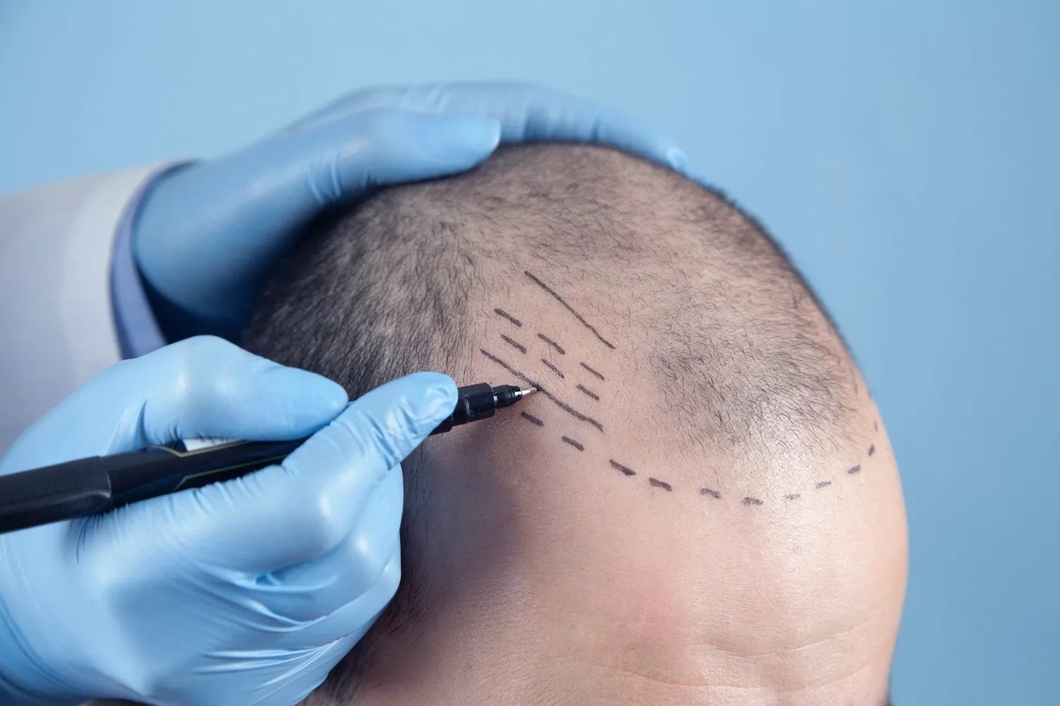 Hair Transplant Cost in Dubai