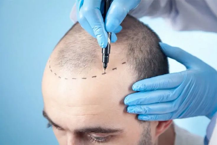 زراعة الشعر في تركيا