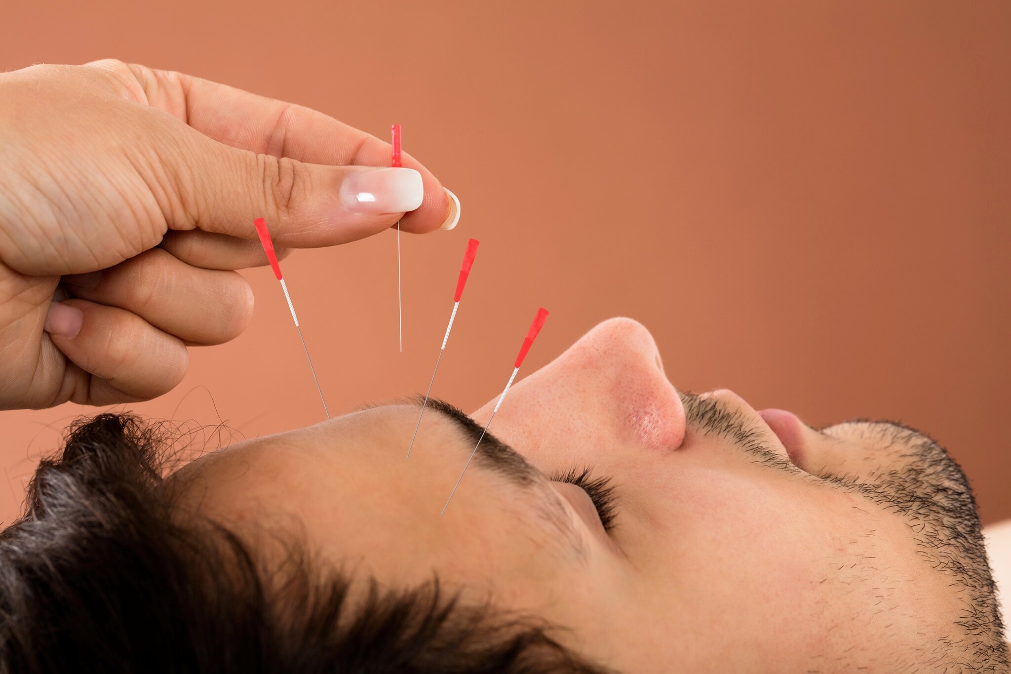 Why Choose a Licensed Acupuncturist for Your Health