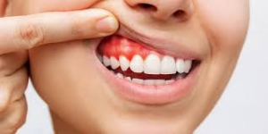 Gum Contouring in Riyadh