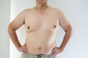 Gynecomastia Surgery in Riyadh