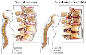 Cervical Spondylitis