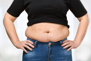 mini tummy tuck in Dubai