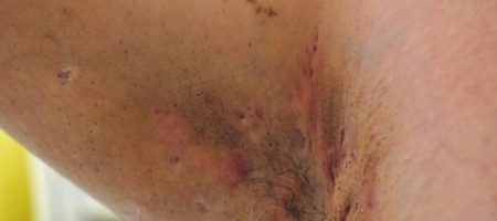 A Complete Guide to Herbal Treatments for Hidradenitis Suppurativa