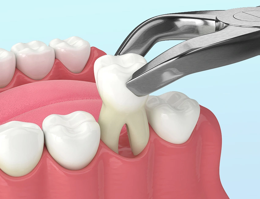Extractions