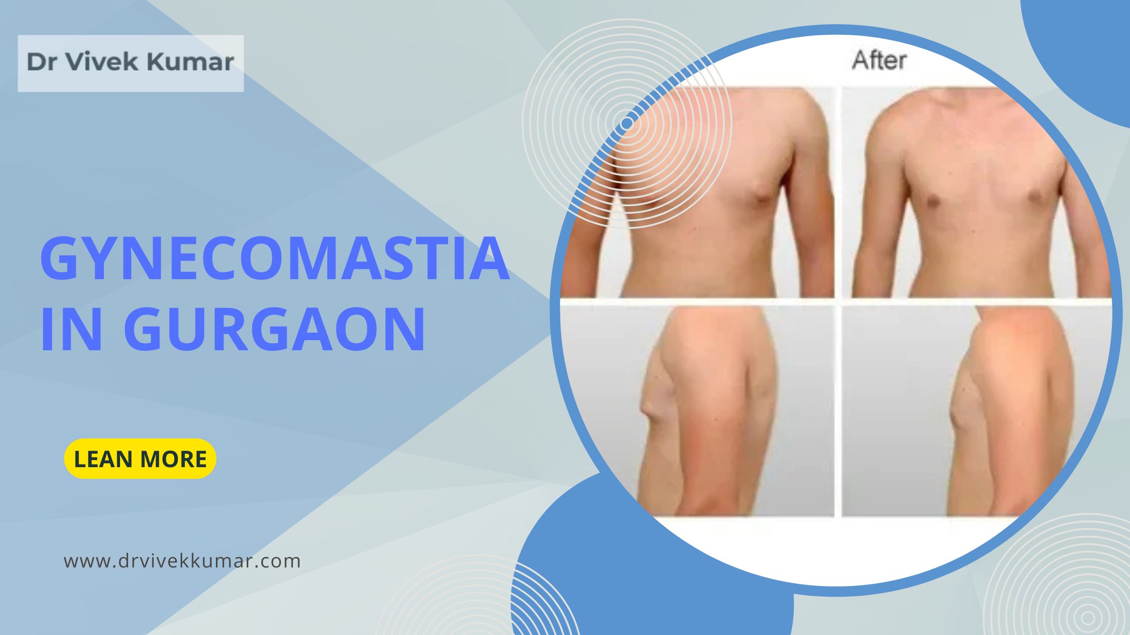 Gynecomastia in Gurgaon