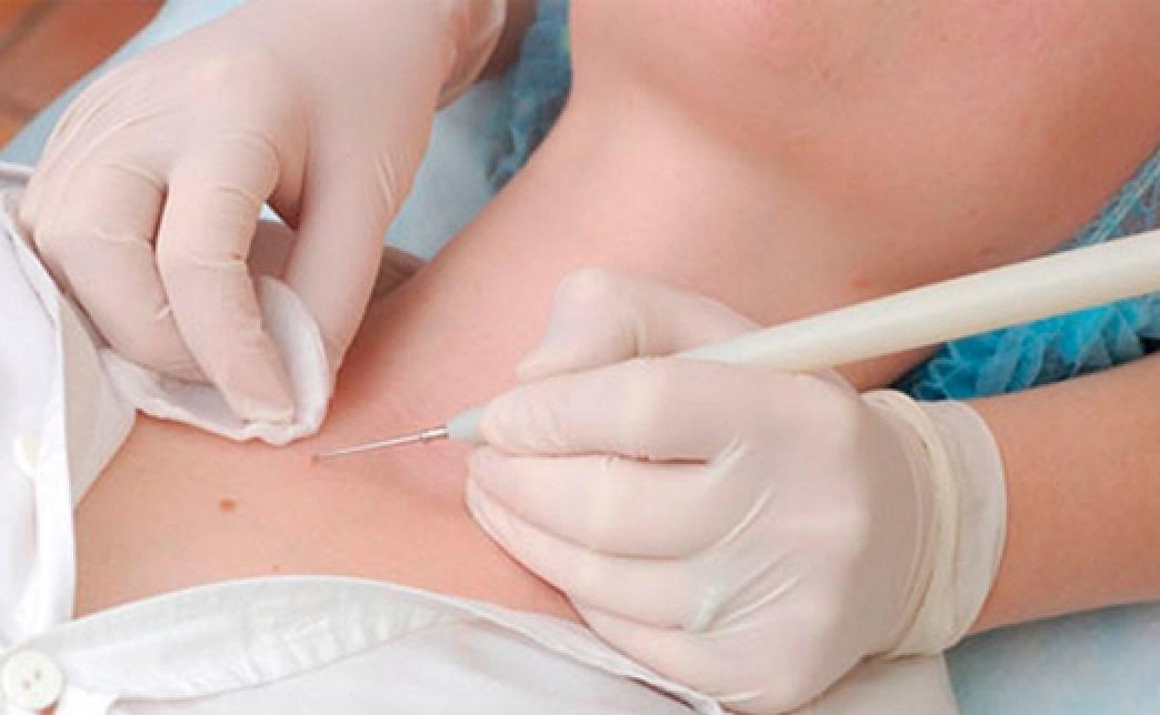 Minor Skin Surgery for Benign Lesions
