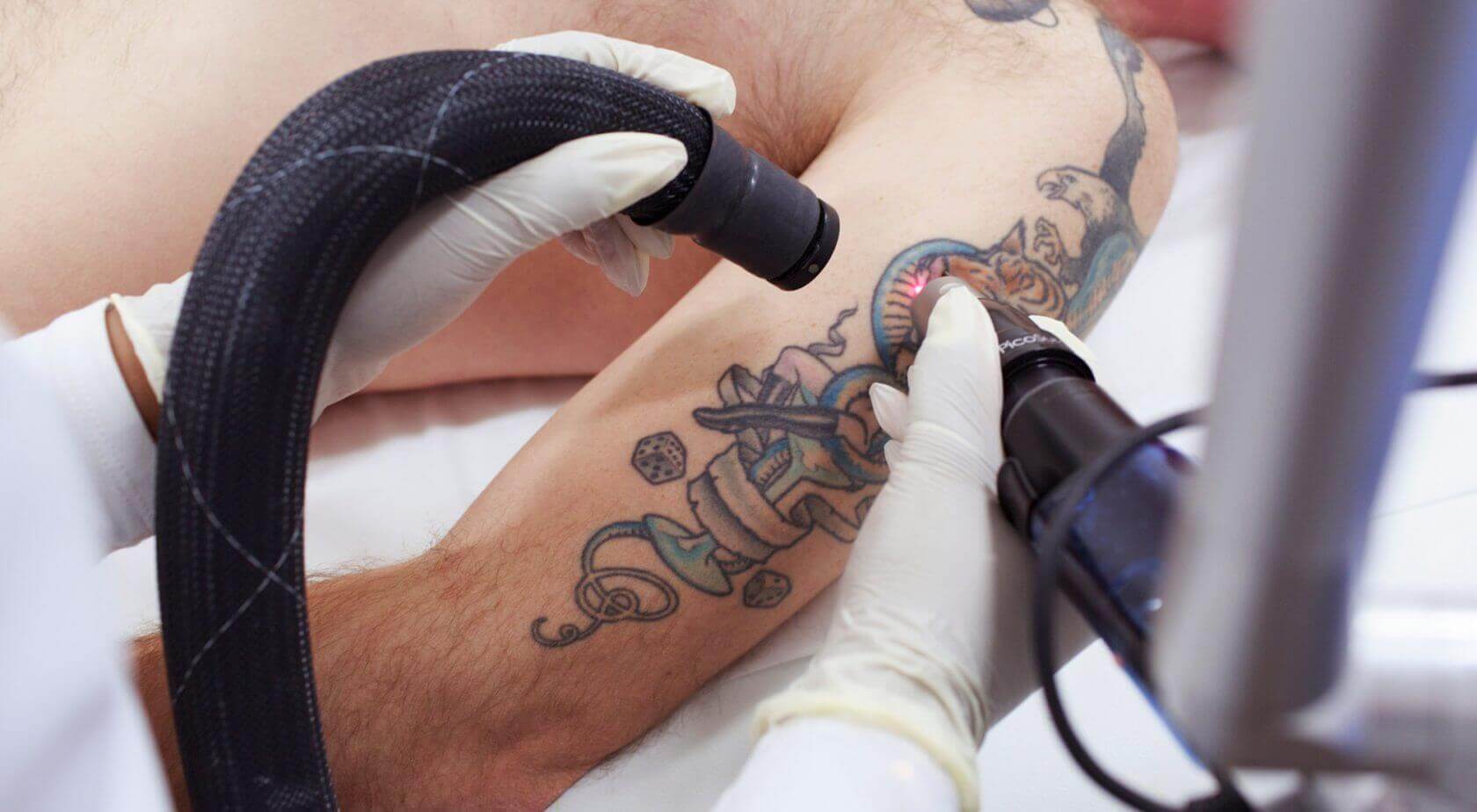 Laser Tattoo Removal in Dubai