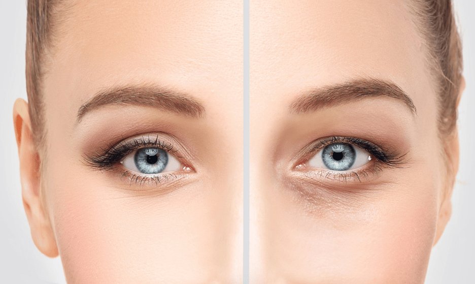 Under Eye Fillers in Dubai