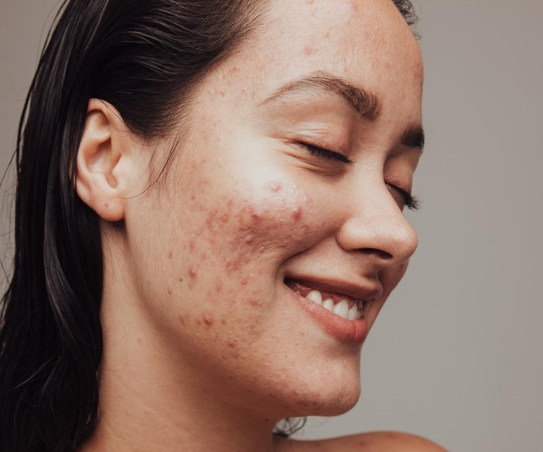 Acne Treatment In Dubai