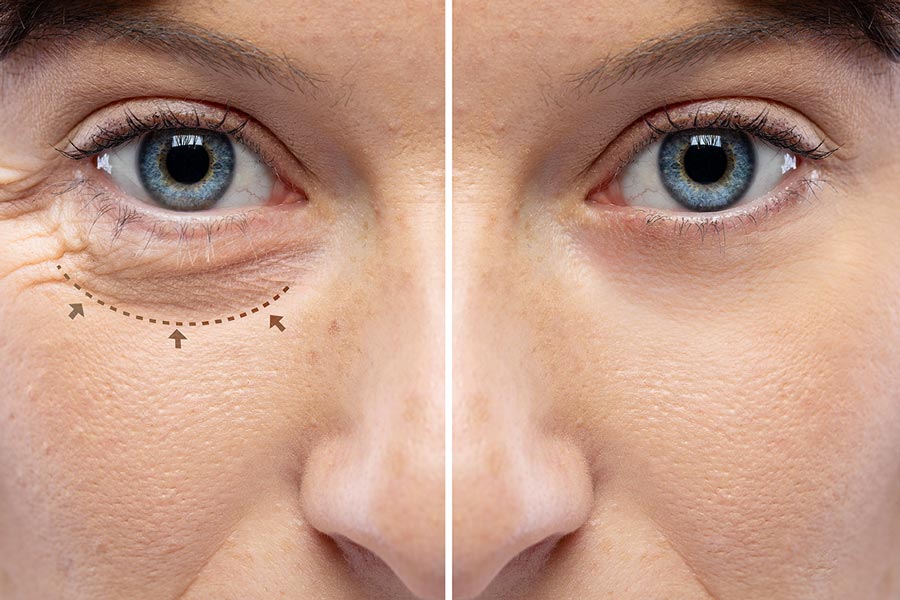 Eyelid Surgery in Riyadh