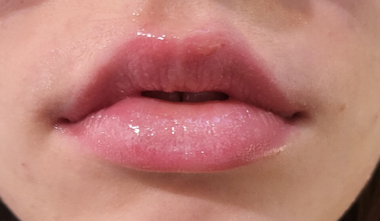 Pink Lips Laser Treatment in Dubai