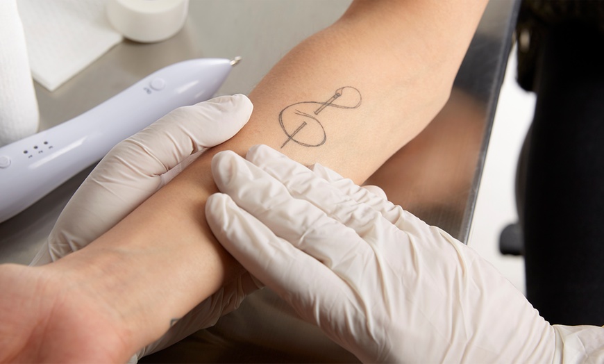 Laser Tattoo Removal in Dubai