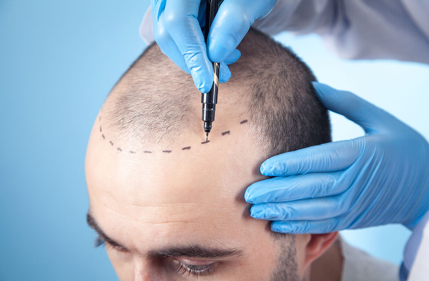 Hair Specialist Doctor in Dubai