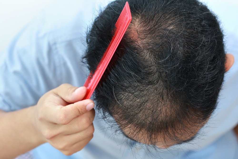Hair Transplant in Dubai