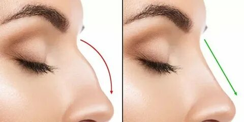 Get the Perfect Nose Job in Chicago