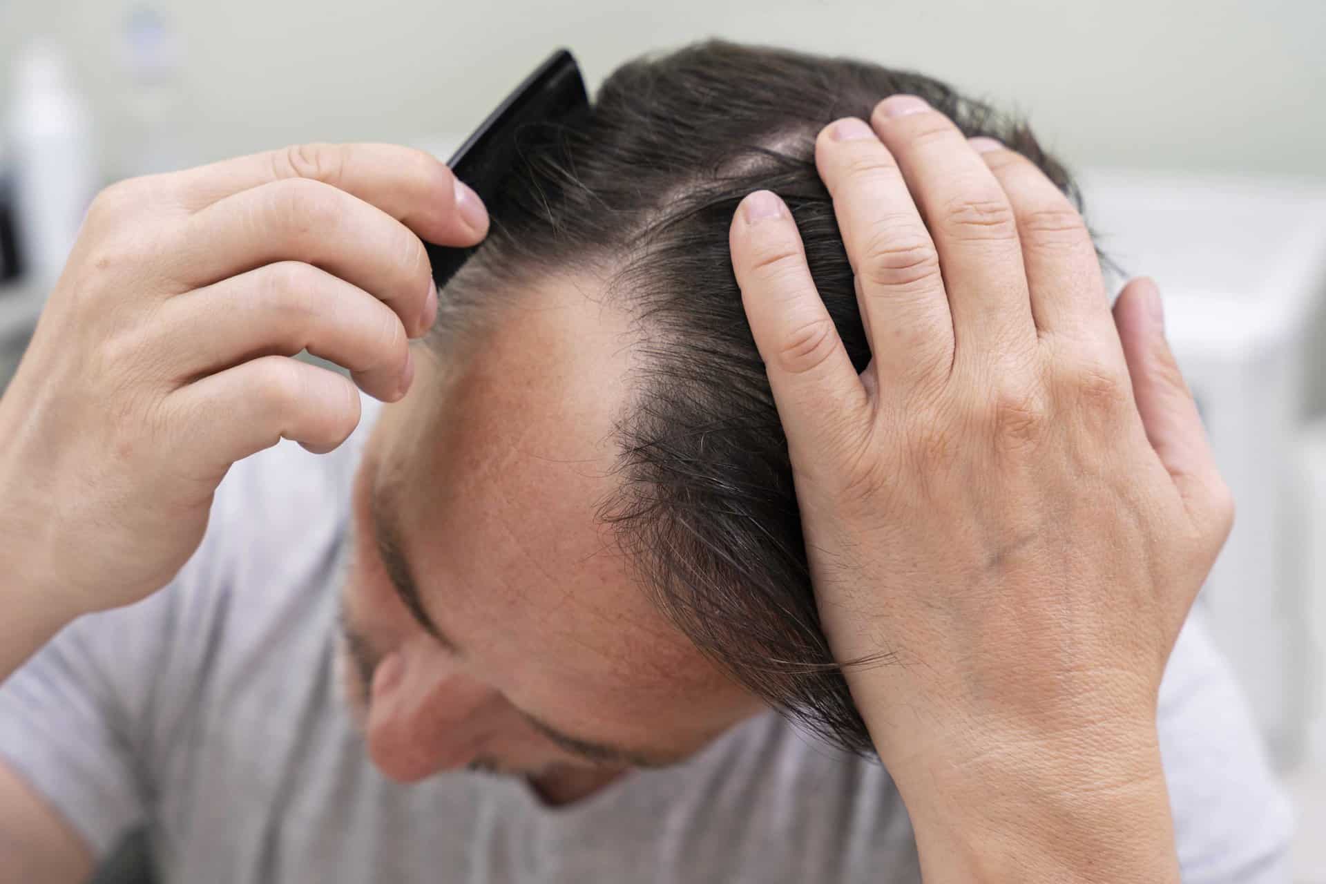 Hair Transplant in Dubai