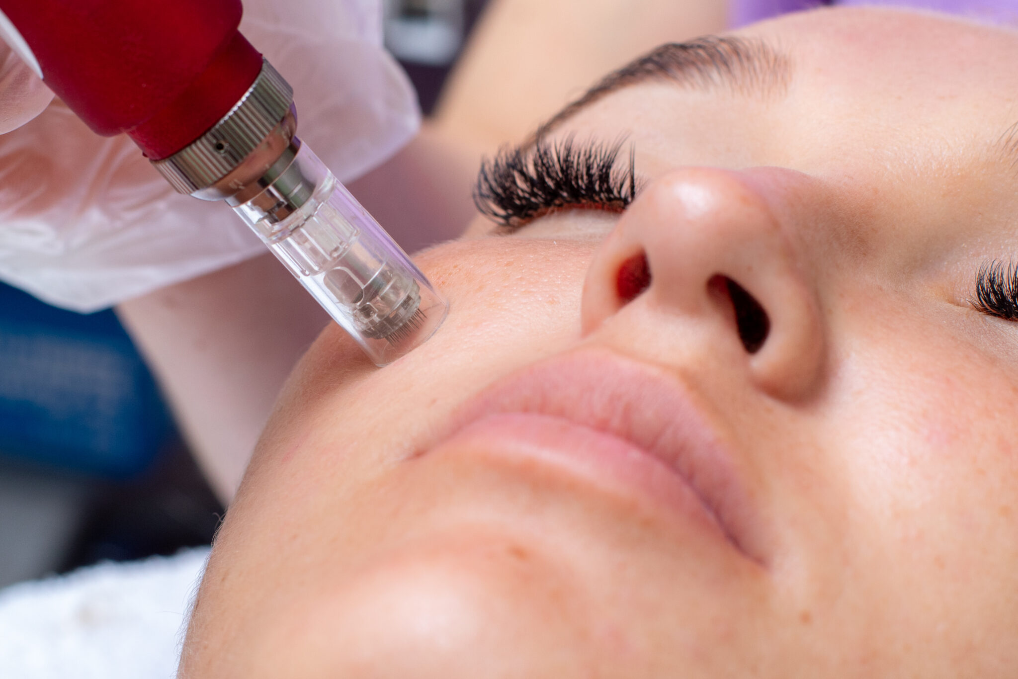 Dermapen Treatment in Dubai