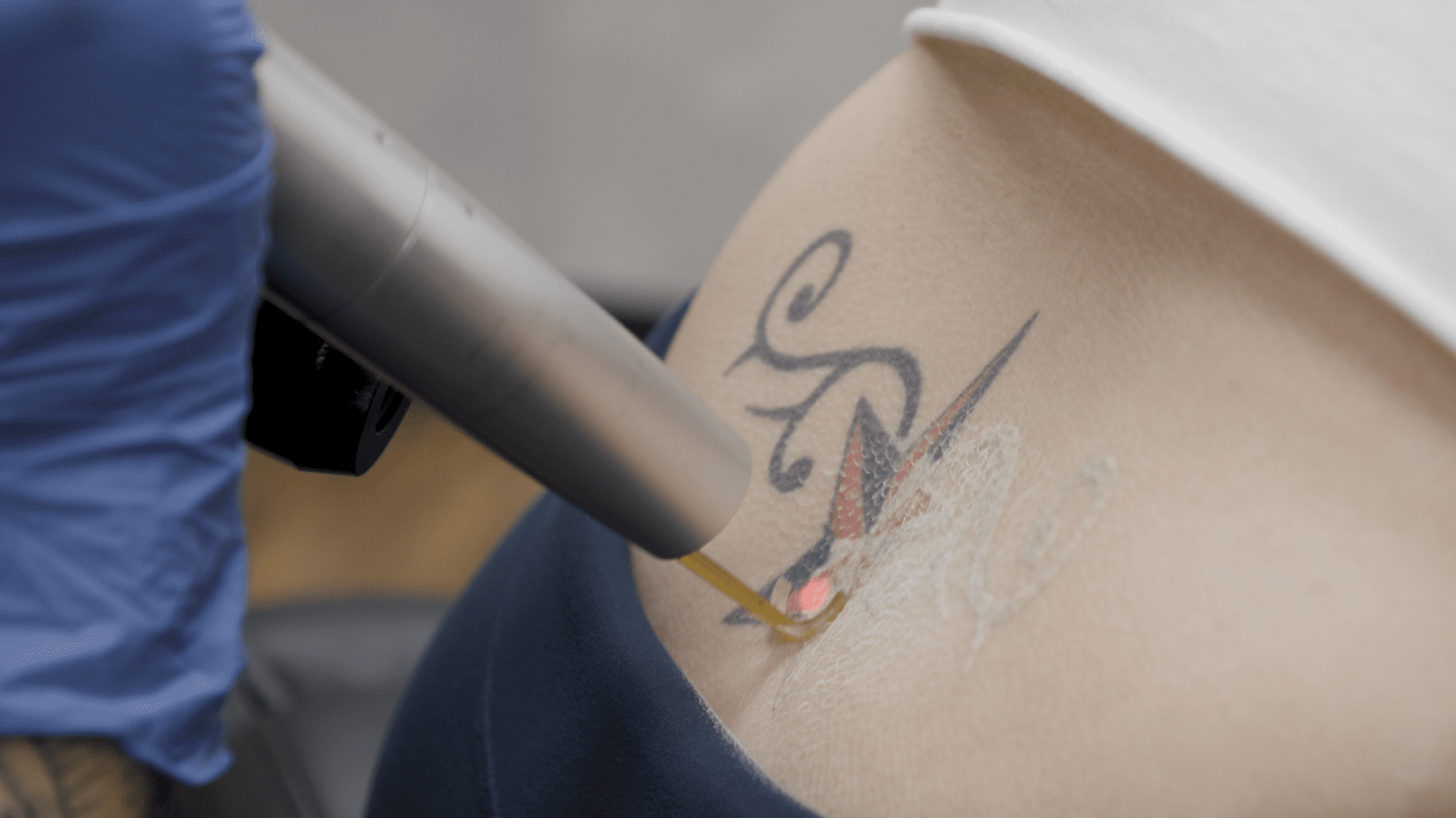 Picosure Tattoo Removal in Dubai