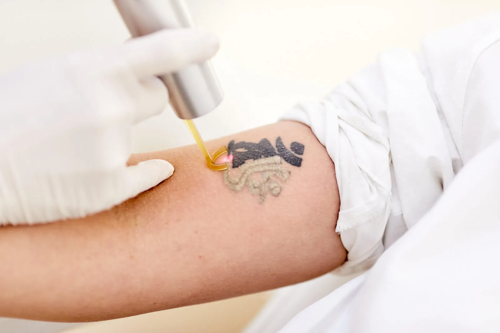 Picosure Tattoo Removal in Dubai