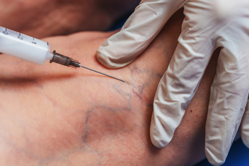 Sclerotherapy A Non-Surgical Vein Treatment Option