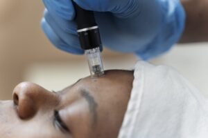 Microneedling Mississauga 