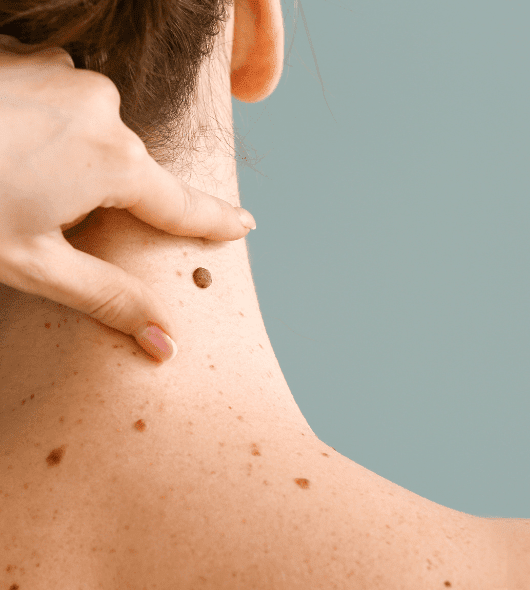 Will Mole Removal Treatment in Dubai Increase or Reduce Future Skin Complications?