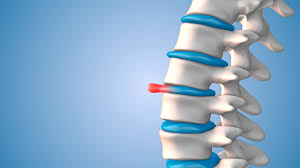 Herniated Disc Treatment in St. Louis
