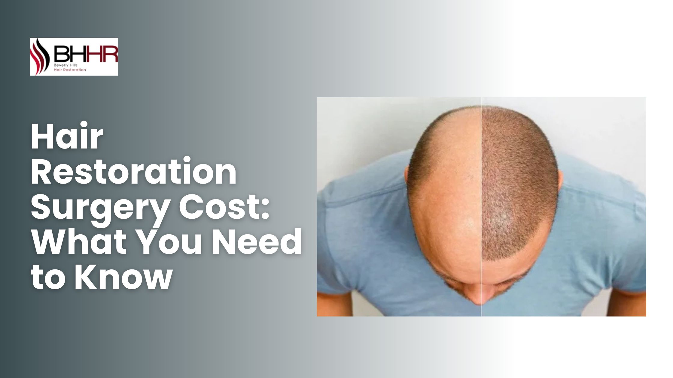 cost of hair restoration surgery