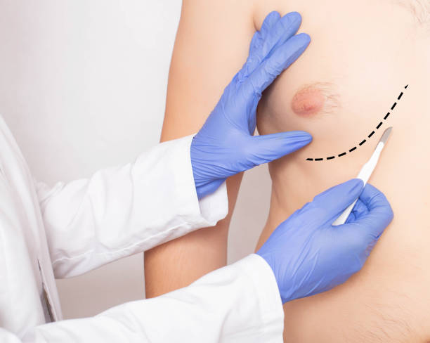 Is Gynecomastia Surgery Painful or Easy to Handle
