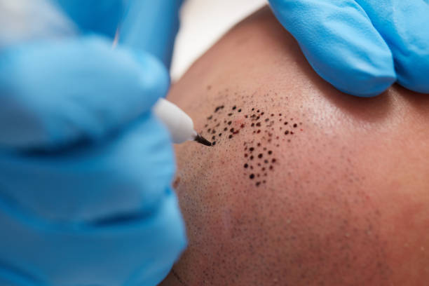 Is Scalp Micropigmentation Cost Fixed or Flexible?