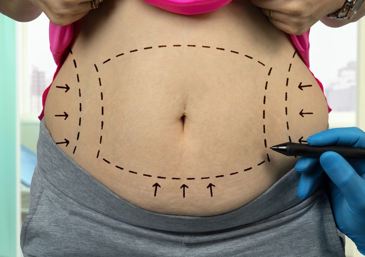 Tummy Tuck in Riyadh