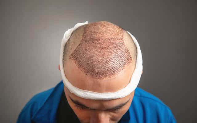 Understanding FUE Hair Transplant Cost Fluctuations