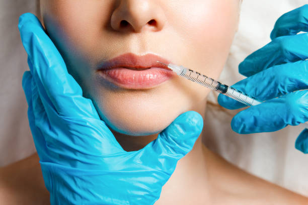 What Are the Benefits of Russian Lip Fillers?