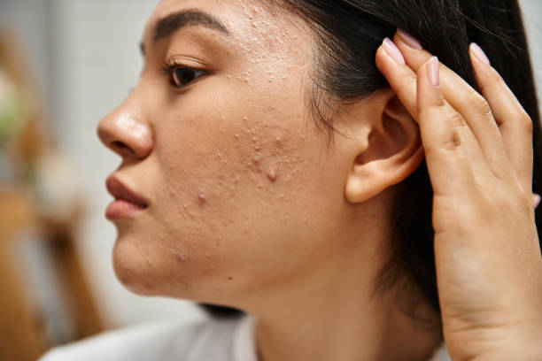 What Makes Acne Treatment Work Faster?