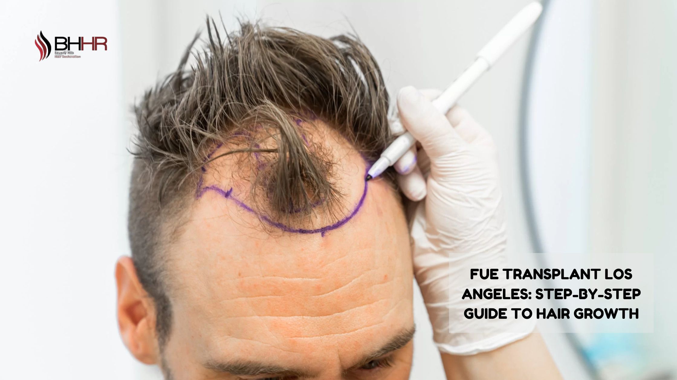 fue transplant los angeles