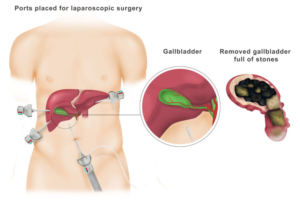 Gallbladder Specialist Singapore: Minimally Invasive Surgery and Patient Care
