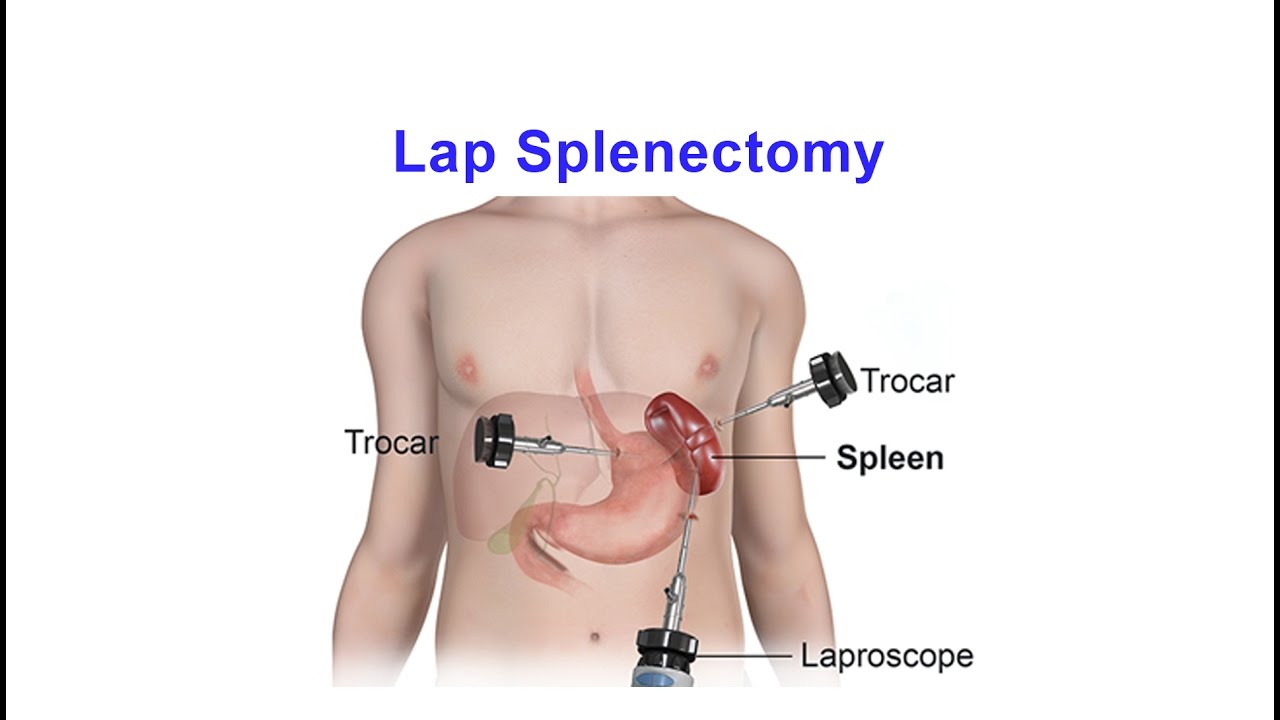 Splenectomy Cost Singapore – Expert Surgical Care at ALPS Clinic