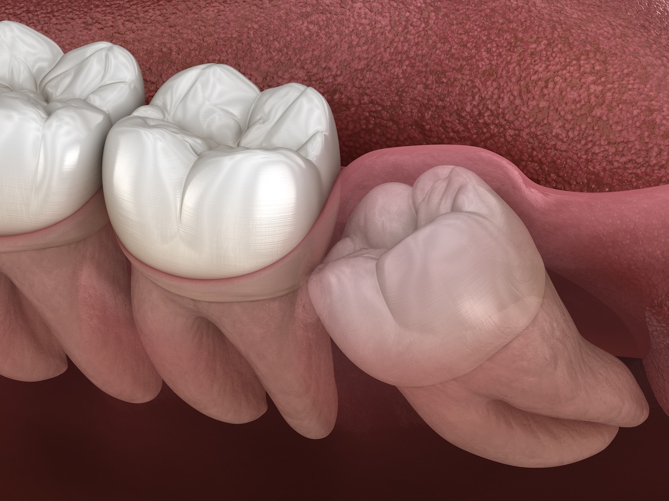 Wisdom Teeth Removal in Paradise Valley, AZ