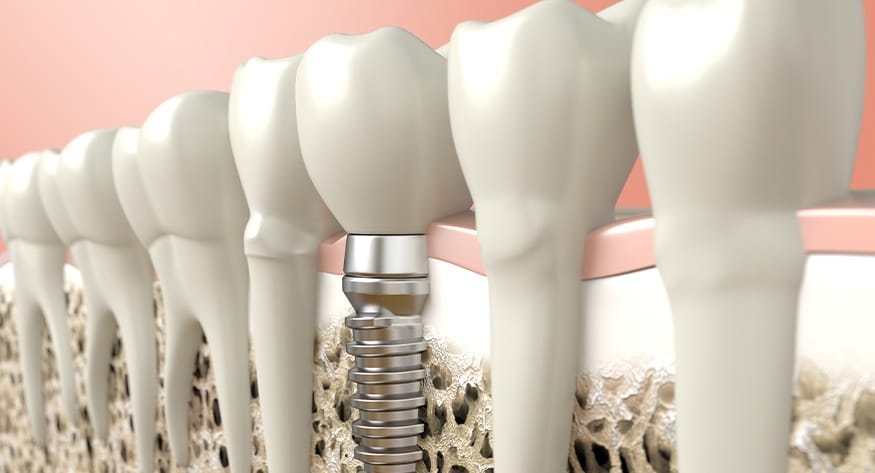 Dental Implants in Litchfield Park, AZ