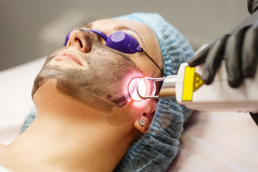 Carbon Laser Peel Treatment