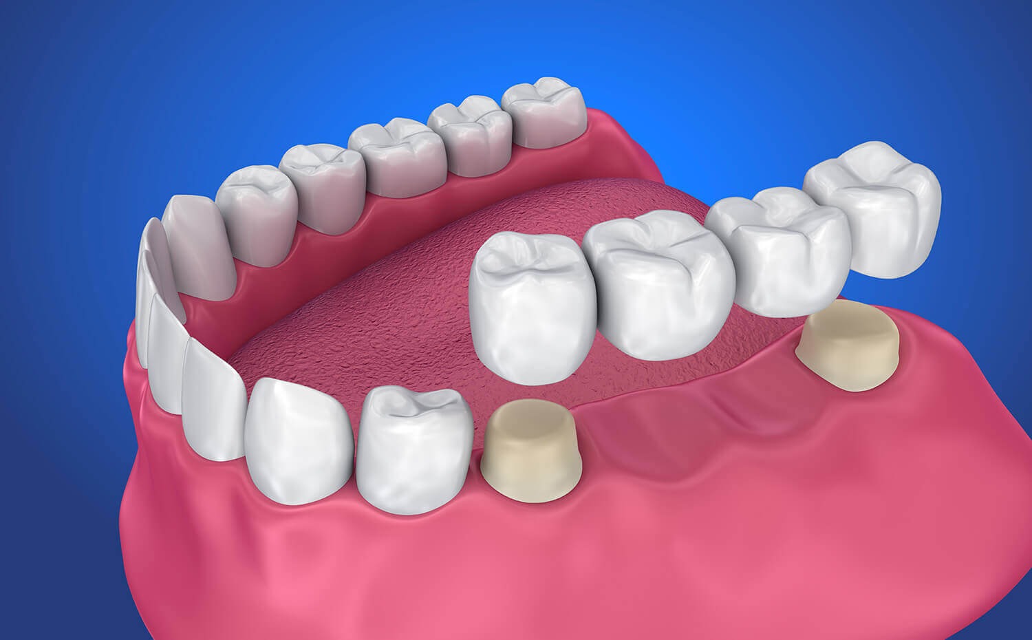 Dental Crowns in Flagstaff, AZ