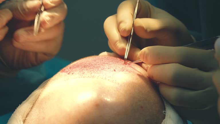 How FUE Hair Transplant Differs from FUT Procedure