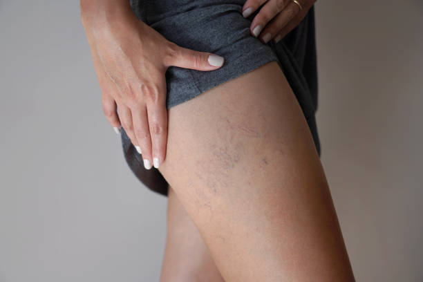 Is Sclerotherapy a Safe Option for Leg Veins?