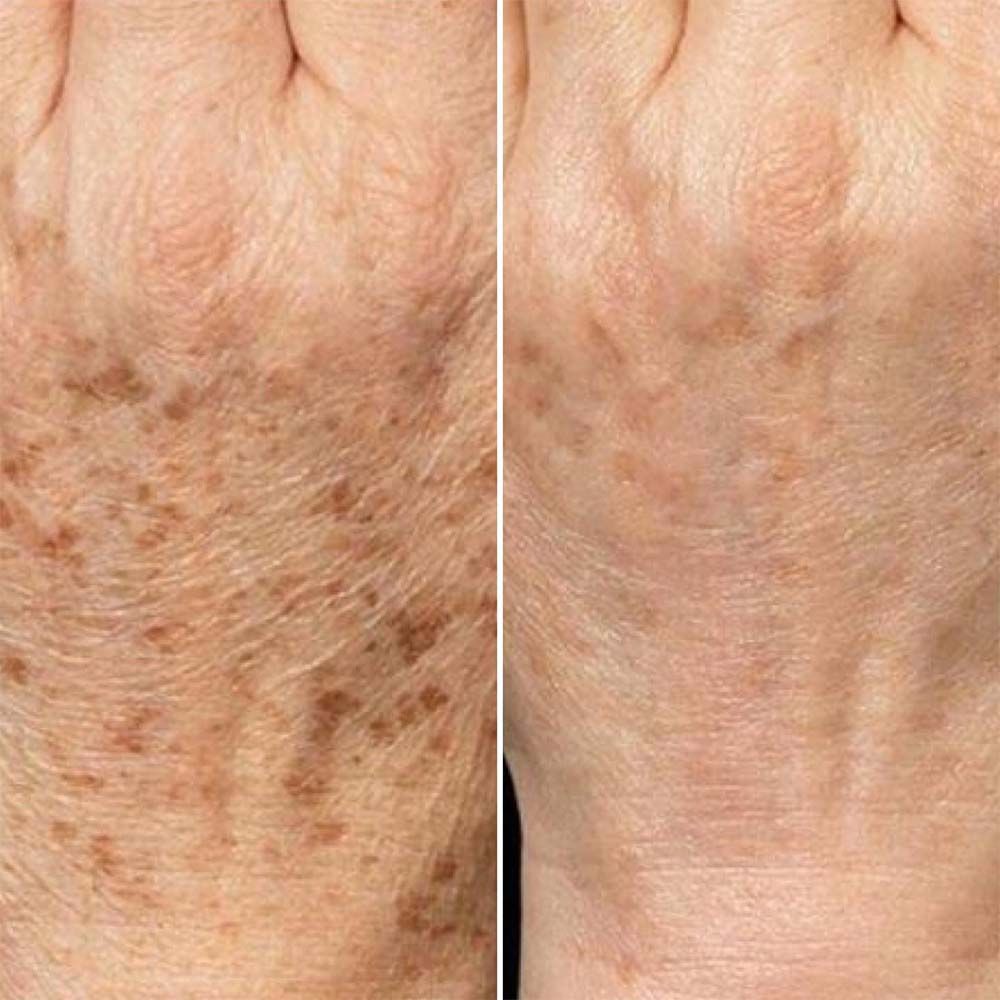 Treatment for Removing Birth Marks