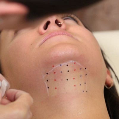 What Areas of the Body Can Kybella Treat