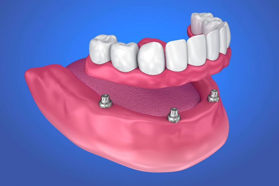 Dentures in Glendale, AZ